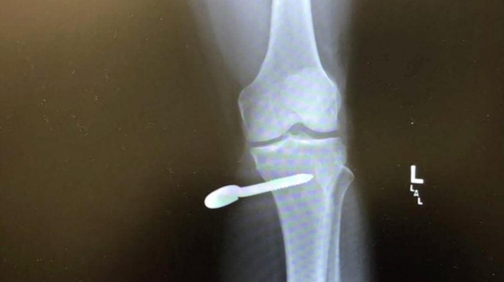 The bolt shot off a boundary rope and impaled the golfer's leg.