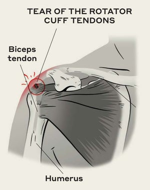 shoulder injury diagram