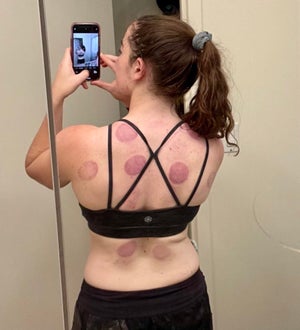 Cupping, while satisfying, does leave a mark.